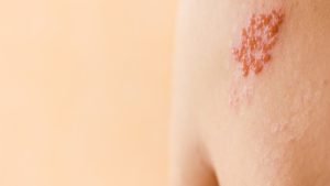 Cần phân biệt đâu là viêm da tiếp xúc khi bị kiến ba khoang đốt và bệnh zona