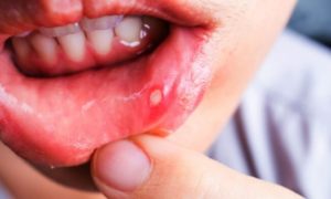 Cách chữa nhiệt miệng đơn giản mà cực hiệu quả tại nhà