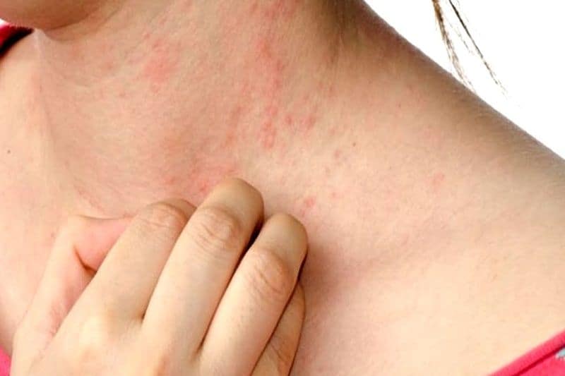 Nhiều người bị dị ứng với hạt chia
