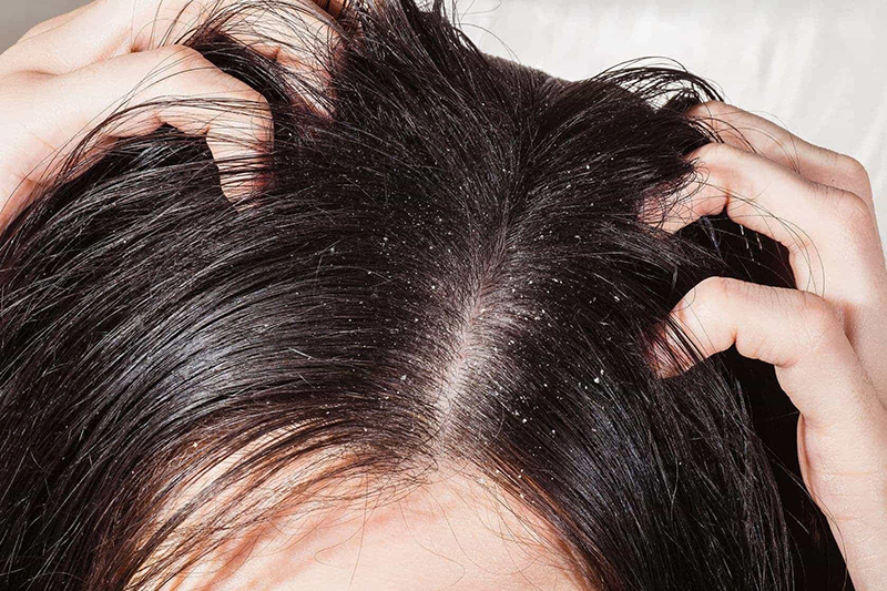 Gàu cũng gây ra rụng tóc - Nguyên nhân và biện pháp ngăn rụng tóc